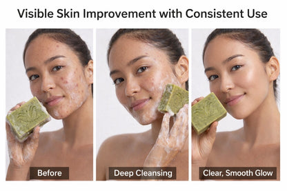 Acne-Prone Skin Therapy Bar Soap – Deep Cleansing, Oil Control, Dark Spot Care –(3-Bars)